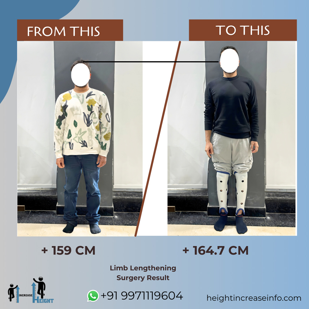 Limb Lengthening Result 1